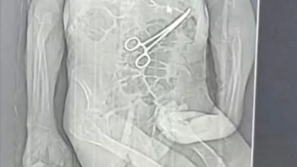 Investigação Sobre Morte de Idoso Após Cirurgia em MG Revela Falha Grave