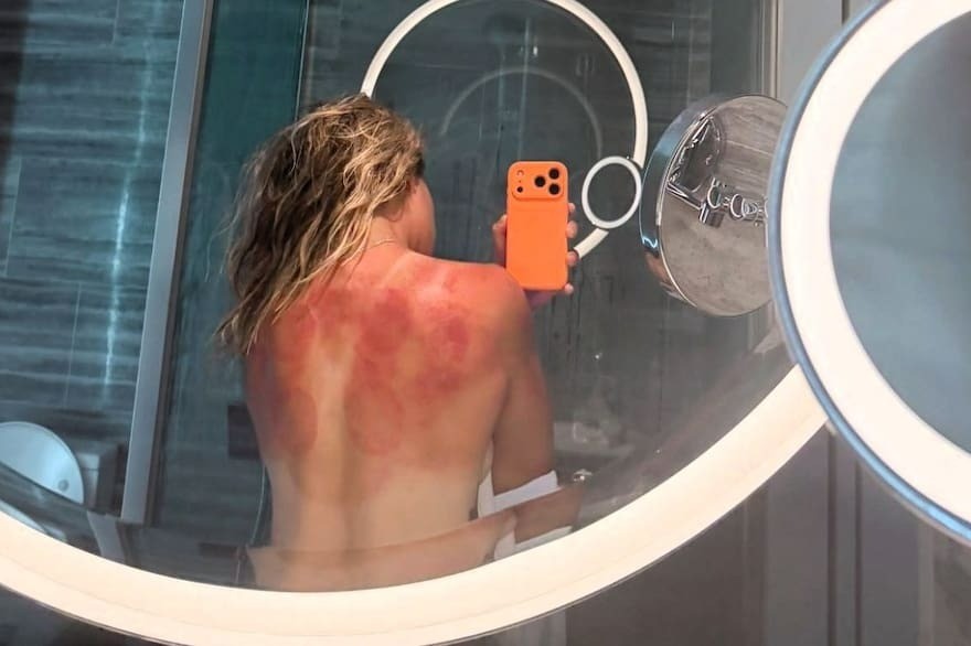 Queimaduras Solares: Como Tratar e Prevenir Este Perigo na Austrália