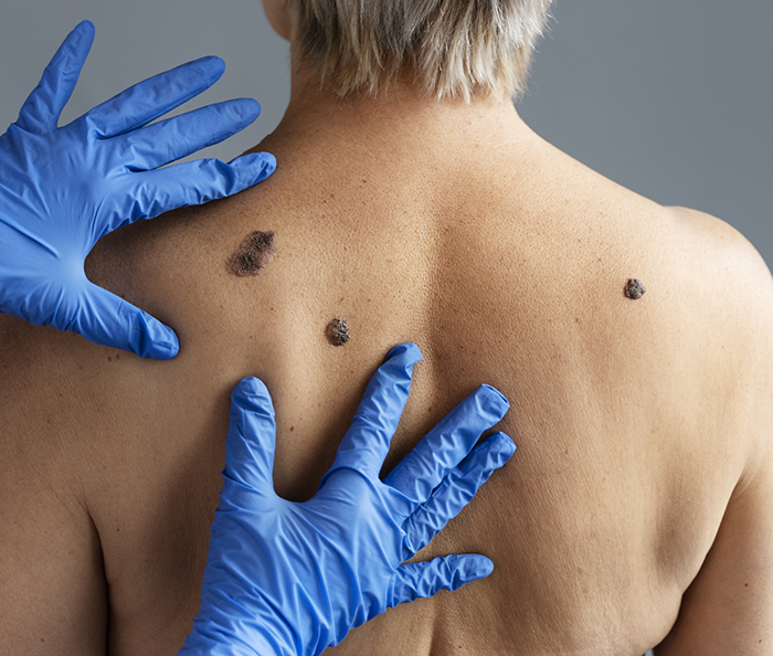 Verão: Prevenção do Câncer de Pele e Uso Correto de Protetor Solar