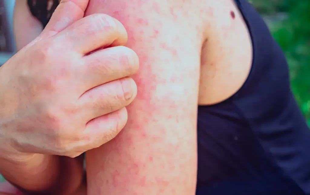 Primeiro caso de sarampo em 2026 confirmado no Rio de Janeiro