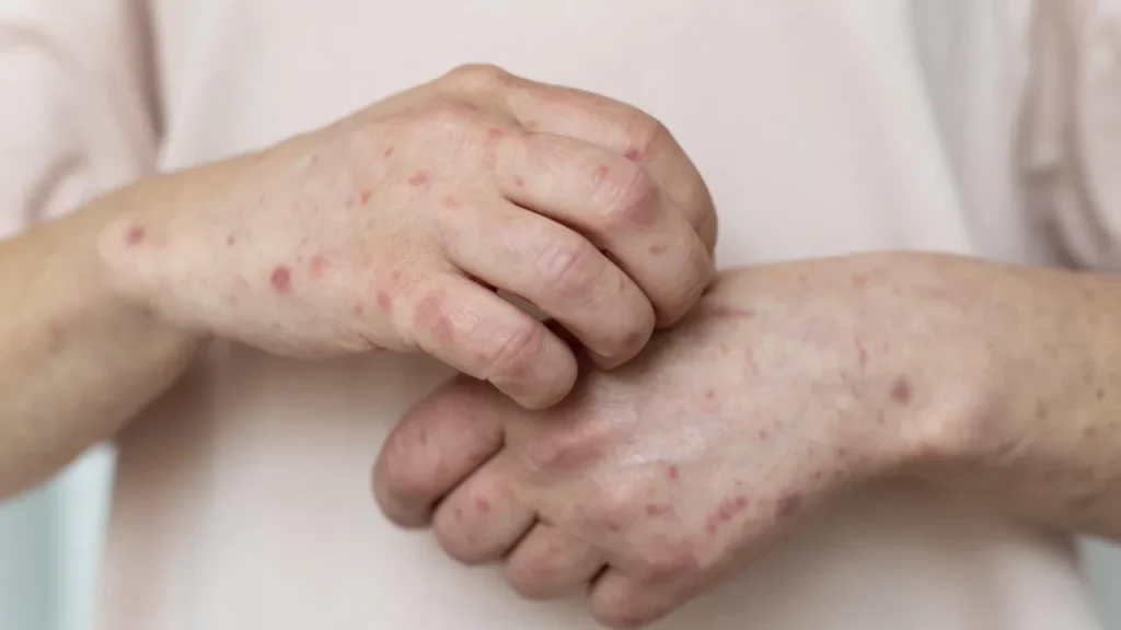 Rio de Janeiro Confirma Caso de Sarampo: Alerta da Saúde Pública