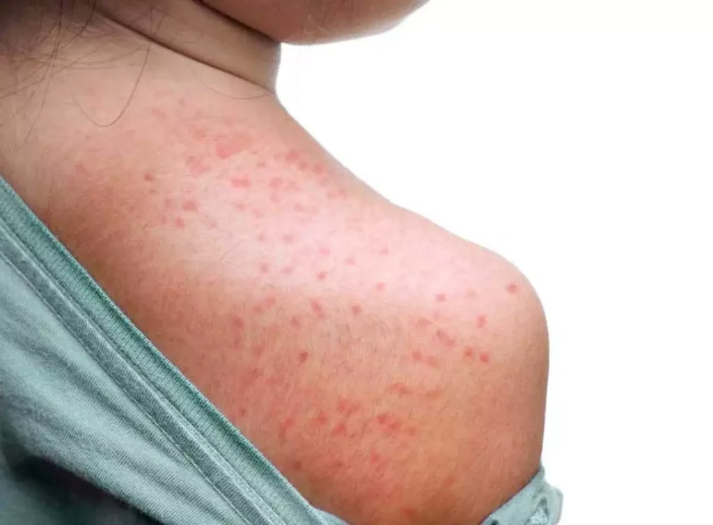 Vacinação contra o Sarampo em Porto Alegre: Um Imperativo de Saúde Pública